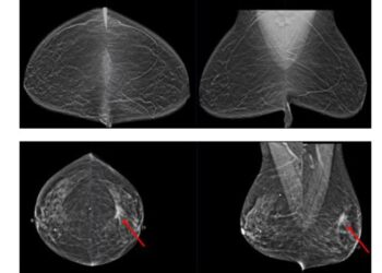 Mammograms with and without cancer