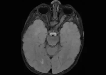 NF1-linked optic glioma