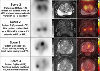 68Ga-PSMA PET/MRI examples of PRIMARY scores.