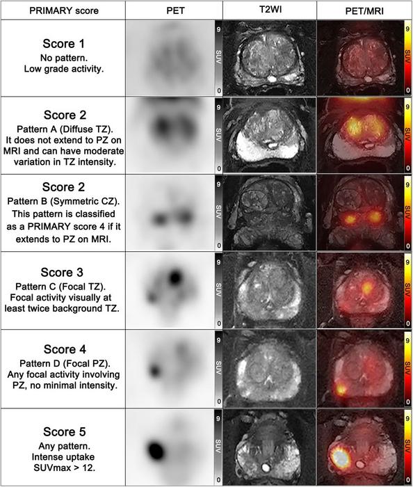 68Ga-PSMA PET/MRI examples of PRIMARY scores.