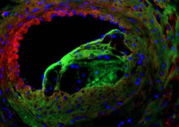 Left anterior descending coronary artery with atherosclerotic lesion immunofluorescently stained for alpha-smooth muscle cell (green), collagen-I (red) and nuclei (blue) in an animal model.