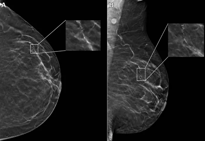 Example mammogram assigned a false-positive case score.