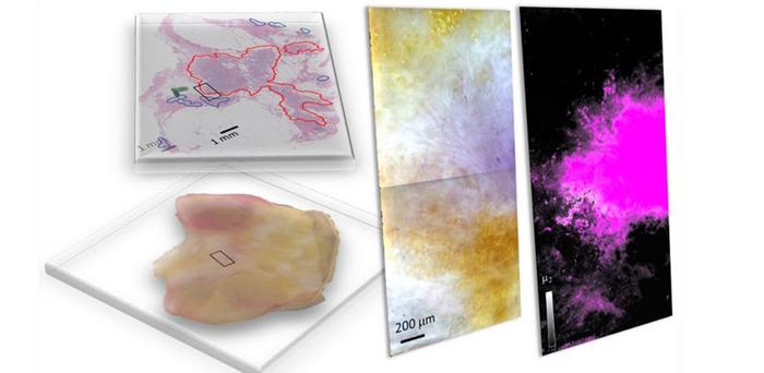 Freshly dissected tissue (lower left) and its pathology-prepared slide with identified tumor regions by a pathologist (upper left), and a pseudo-color image of hyperspectral dark-field microscopy (HSDFM) data cube (middle) region marked on tissue images.