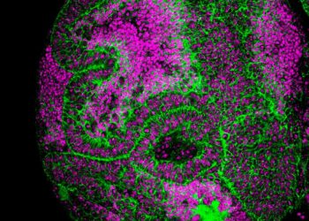 Germ line thioredoxins effect on somatic Drosophila tumour