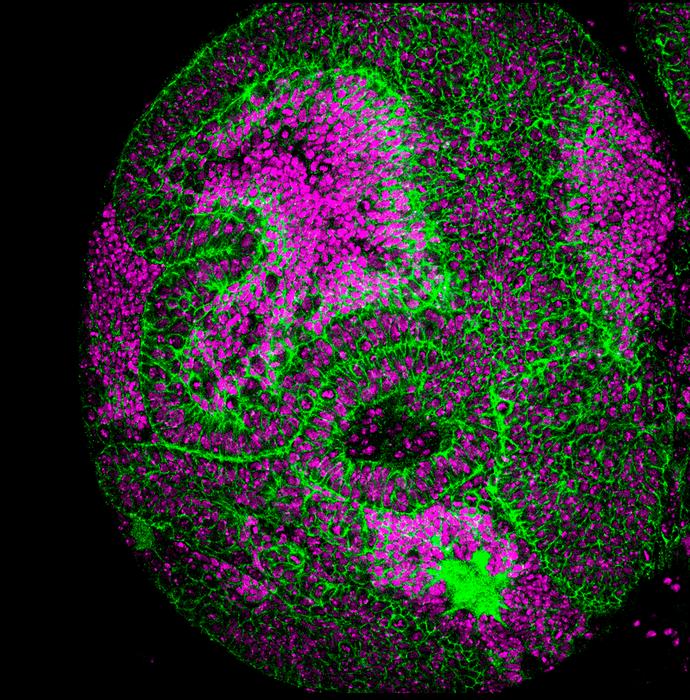 Germ line thioredoxins effect on somatic Drosophila tumour
