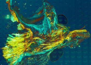 Calcium nodules in aortic valve