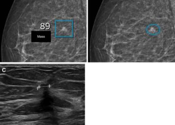 Images in a woman who had a BI-RADS density of 2.