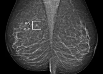 Screening mammogram of a 57-year-old woman
