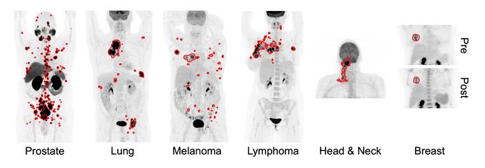Illustrative examples of the predicted tumor segmentations by the deep transfer learning approach across six cancer types.