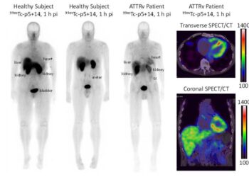 99mTc-p5+14 SPECT/CT imaging of cardiac amyloidosis