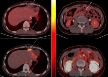 PET/CT Imaging of CLDN18.2 Expression