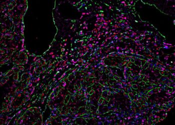 Macrophages in kidney cancer