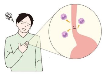 Chronic allergic disorder eosinophilic esophagitis (EoE)