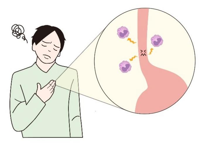 Chronic allergic disorder eosinophilic esophagitis (EoE)