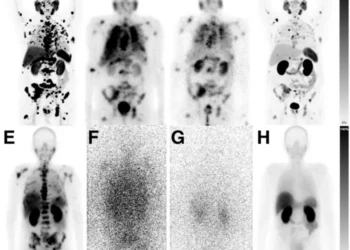 Lower dose prostate cancer treatments retain efficacy while improving tolerability.