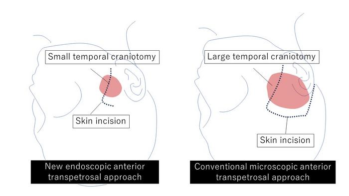 Diagram of skin incision and extent of craniotomy
