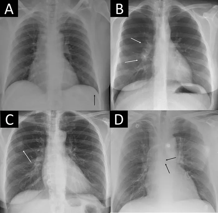 Four examples of remarkable chest X-rays with missed critical findings