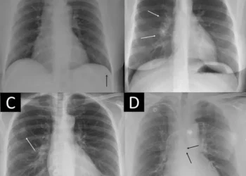 Four examples of remarkable chest X-rays with missed critical findings