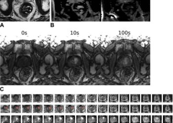 Images in a 64-year-old male patient who underwent MRI for clinical suspicion of prostate cancer