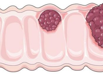Cancers of the digestive system are on the rise globally