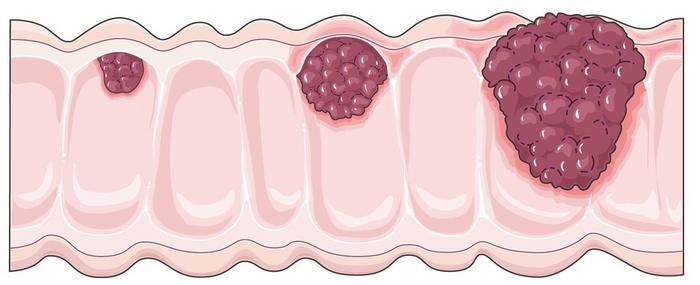 Cancers of the digestive system are on the rise globally