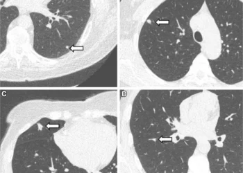 Representative chest low-dose CT images show lung nodules (arrows)