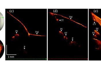 A newly developed otoscope incorporates combines the familiar otoscopic view with high-resolution imaging of the inner structures of the TM and middle ear, offering a clearer and more comprehensive view.