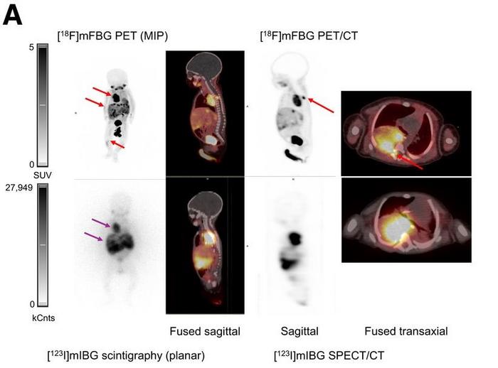 Molecular imaging of 7-wk-old girl with neuroblastoma.