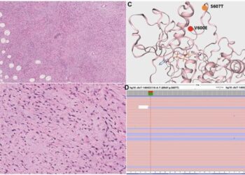 Rapid but nondurable response of a BRAF exon 15 double-mutated spindle cell sarcoma to a combination of BRAF and MEK inhibitors