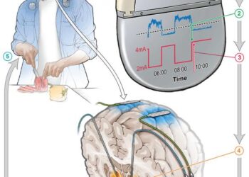 Adaptive DBS system for Parkinson's Disease