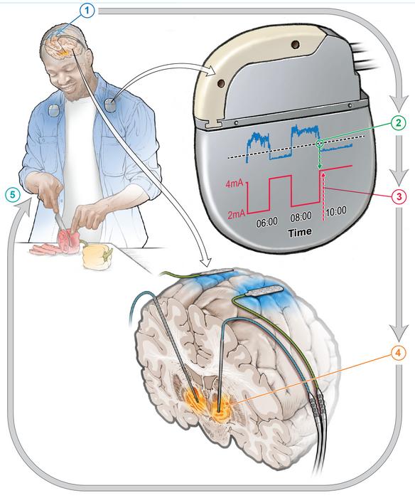 Adaptive DBS system for Parkinson's Disease