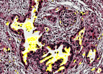 Pancreatic tissue with the biomarker CA199.STRA in yellow Credits: