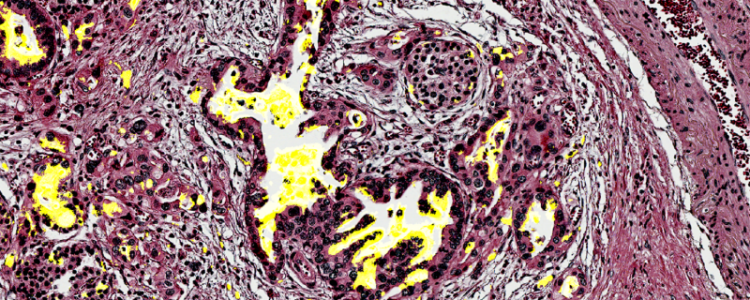 Pancreatic tissue with the biomarker CA199.STRA in yellow Credits: