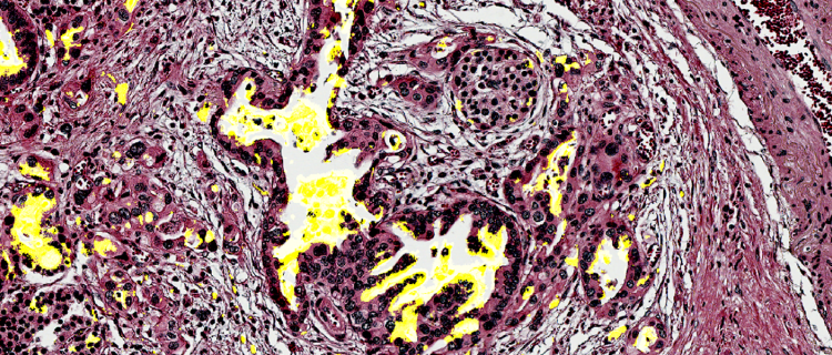 Pancreatic tissue with the biomarker CA199.STRA in yellow Credits: