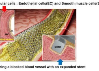Transforming Cardiovascular Surgery: Laser Patterning Technology Innovates Stent Design