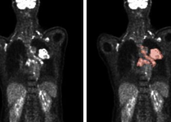 Automated methods enable the analysis of PET/CT scans (left) to accurately predict tumor location and size (right).