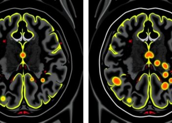 Breakthrough Imaging Techniques Reveal Concealed Metastases in High Risk Prostate Cancer Patients