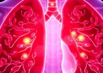 New Lung Cancer Test Outperforms Traditional Methods in Predicting Early-Stage Survival