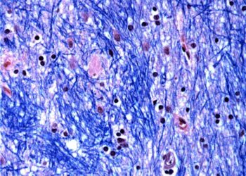 Histological staining of the caudate nucleus from a person with Huntington's disease