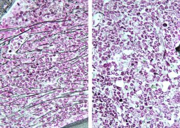 Drug in clinical trials for breast cancer could also treat some blood cancers