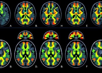 Research Focus: Enhancing Brain Cancer Outcome Predictions Through Optimal Imaging Criteria