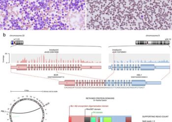 Chronic myeloid leukemia, Chronic phase and Philadelphia chromosome (BCR::ABL1 fusion gene)