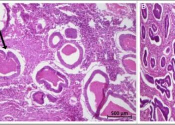 Diffuse cystic adenomyosis simulating invasive uterine neoplasm on imaging: A postmenopausal diagnostic perplexity!