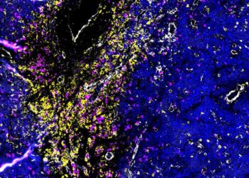 Accumulation of different types of immune cells in a bone marrow lesion with breakout myeloma cells