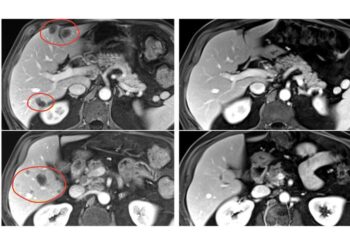 TIL liver mets image