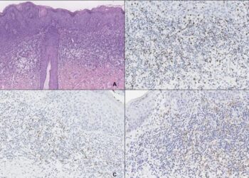 PD-L1 and FOXP3 expression in high-grade squamous intraepithelial lesions of the anogenital region