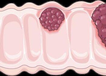 Colorectal cancers with high tumor mutation burden may have unique mechanisms of carcinogenesis