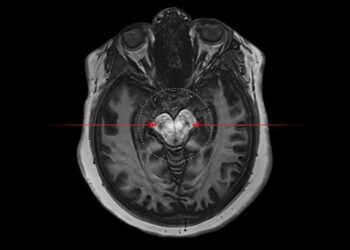 Findings showed amount of cannabis people intake is directly proportional to the change in dopamine levels seen in the brain