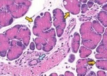Pancreatic cancer cells