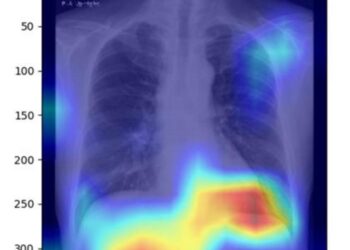 AI decision-making process with chest X-ray images